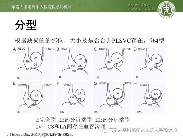 无顶冠状静脉窦综合征