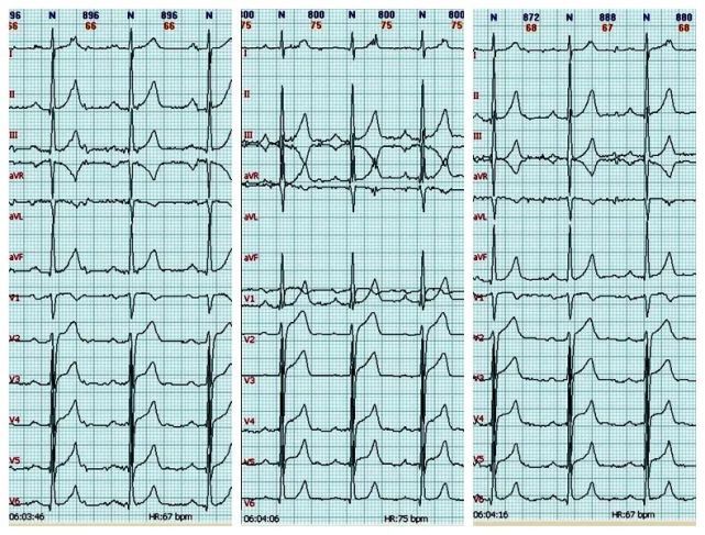 心电图图例分析7变异性心绞痛心电图改变