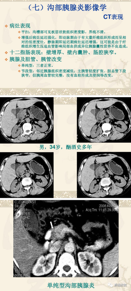 沟槽区胰腺炎丨临床及影像表现