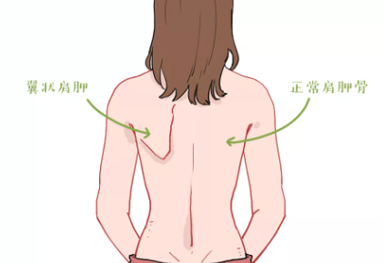 明显突出而翼状肩胛的患者应该是紧贴胸壁的正常人的肩胛骨翼状肩胛