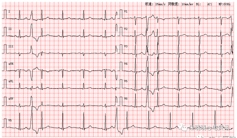 患者男,63岁,图为其正常体检心电图