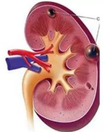 灵魂拷问:肾囊肿切or不切?