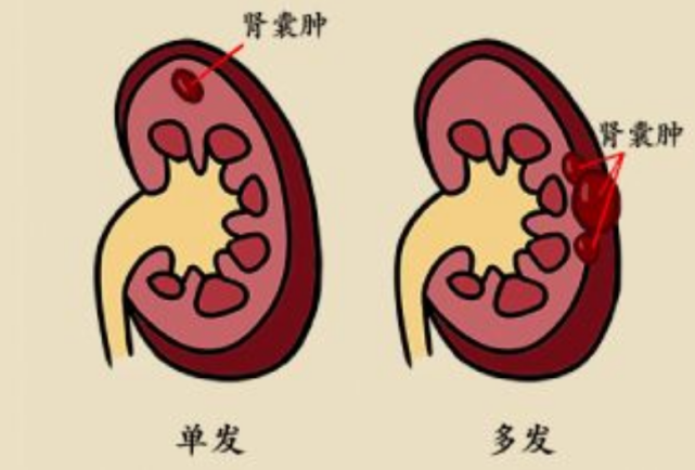 灵魂拷问肾囊肿切or不切