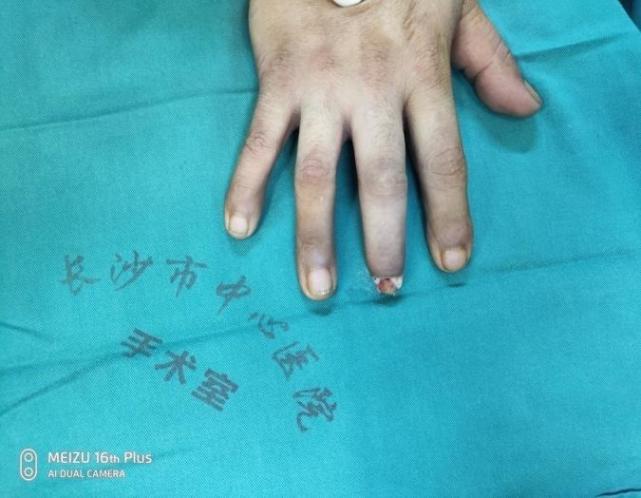 男子手指被割断,辗转2个月求医,手足显微团队移花接木,脚趾变拇指