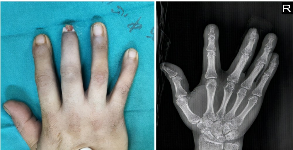 男子施工致手指末节离断手指再造术助他圆残缺之憾