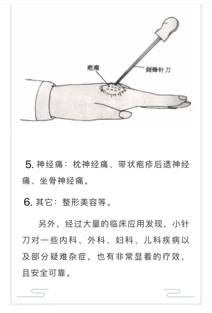 健康小讲堂小针刀大疗效