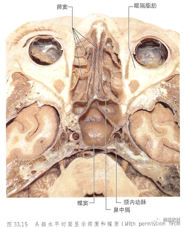 筛窦和蝶窦鼻窦ct矢状位来源:熊猫放射01.培养一个医生有多难02.