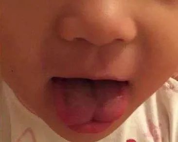 看看自家娃的舌头,如果出现这种形状,一定要注意!