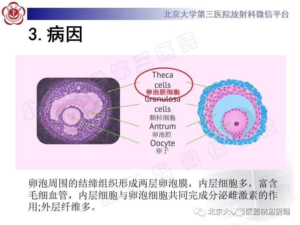 卵巢纤维卵泡膜细胞瘤影像表现