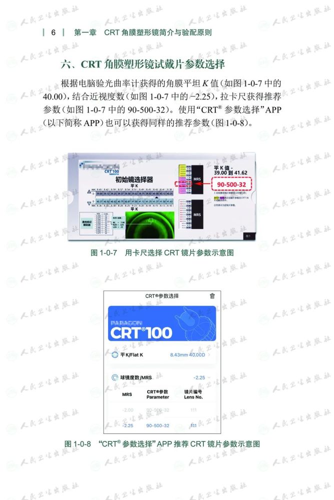 角膜塑形镜验配经典案例解析crt角膜塑形镜验配的经验总结打通vstcrt