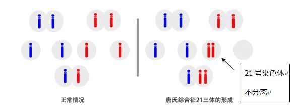 lejeune首先确认本病患者细胞中多了一条21号染色体故称21-三体综合征