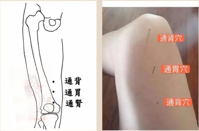 中医针灸下肢疾病处方9