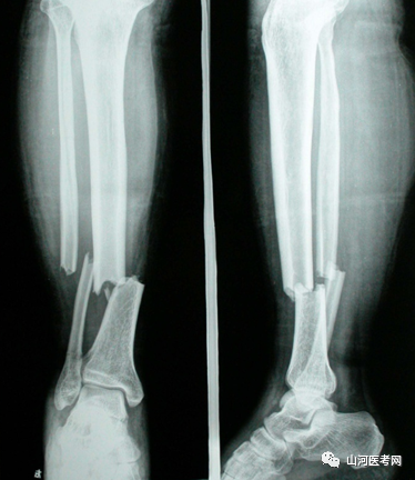 五,影像学检查胫骨下1/3螺旋形骨折合并后踝骨折导,多数合并后踝骨折.