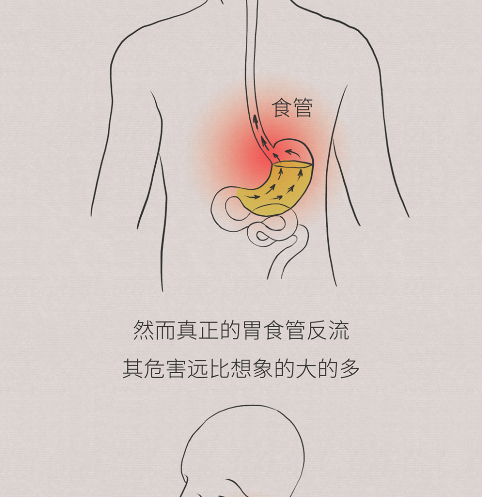 肠画短说烧心反酸这种疾病可不是你想的那么简单