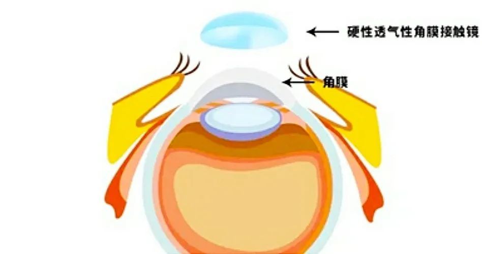 角膜接触镜有哪几类