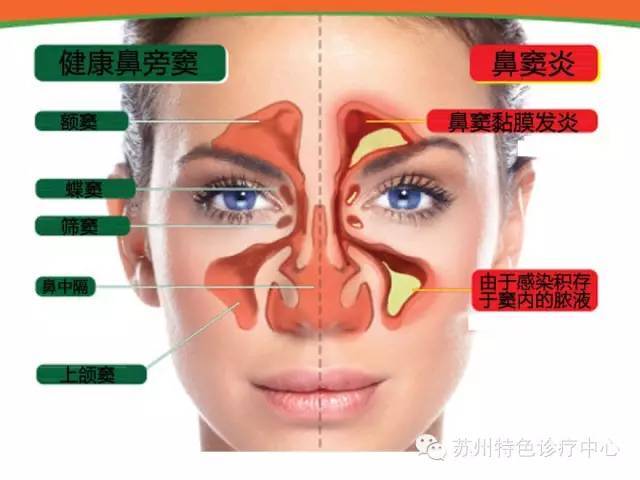 【科普】鼻炎长期不治,后果原来这么可怕