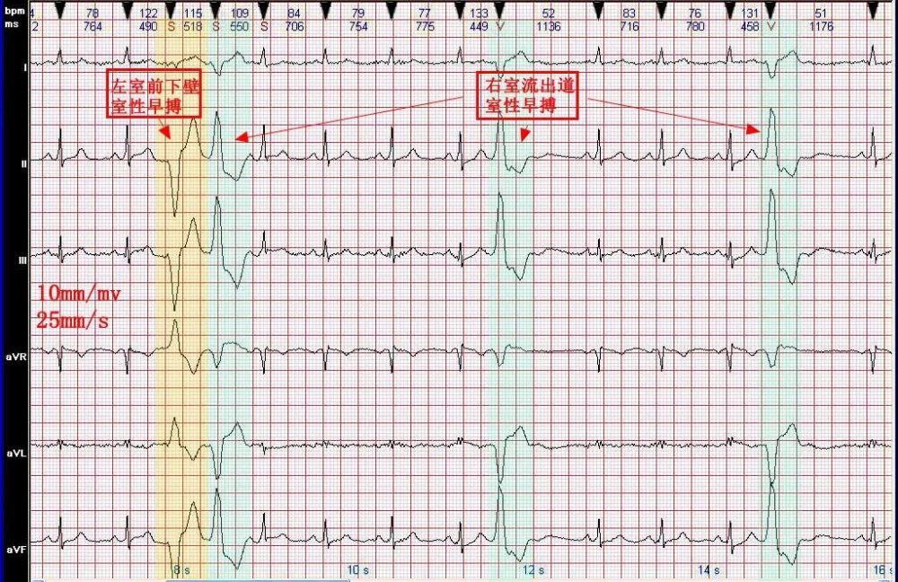 心电图图例分析8双源性室性早搏部分呈连发