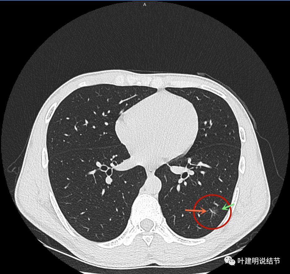 19:同为肺磨玻璃结节,一让尽快手术,一让随访不急,玄机在哪?