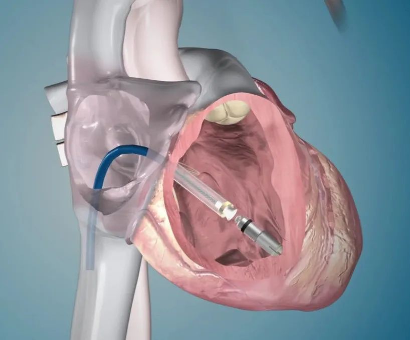 micra微型无线起搏器微型无线起搏器的出现使心脏手术进入新纪元.