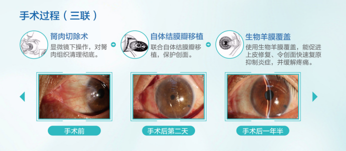 六旬老人眼睛里长出小翅膀原来是翼状胬肉在作怪