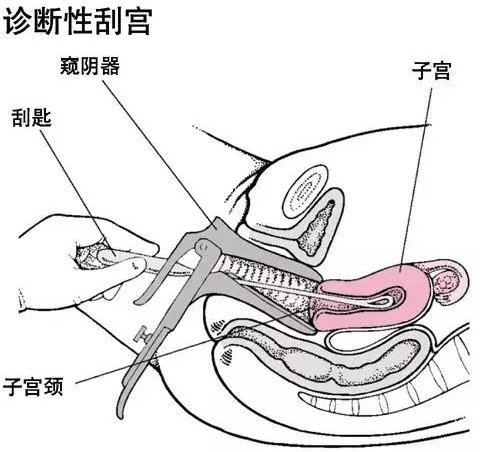 刮宫和人流,哪一个对女性伤害更大?