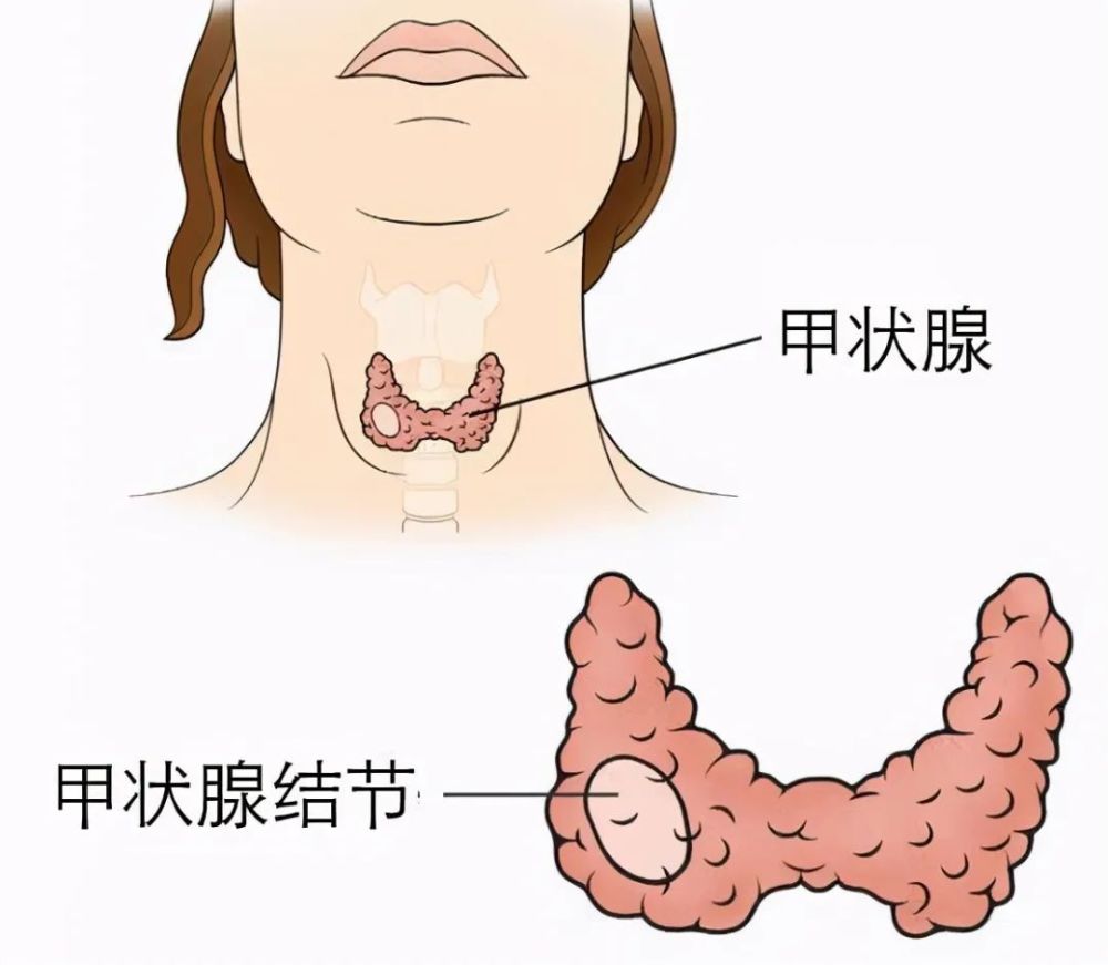 是目前判断甲状腺癌及其颈部转移性淋巴结的重要方法,有较高的灵敏度