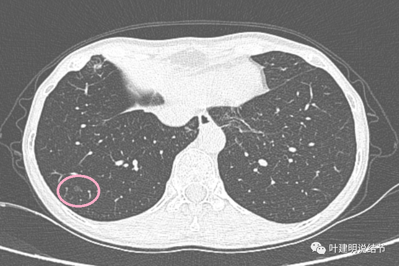 11.20):这样的肺部片状影会是什么性质?