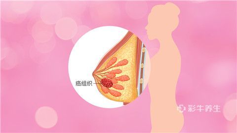 乳腺癌复发的前兆