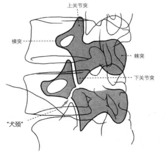 腰椎峡部裂外科手术治疗综述