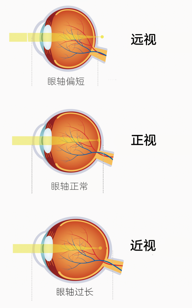 可以把眼球发育理解成是一个「吹气球」的过程,气球表面相当于视网膜.