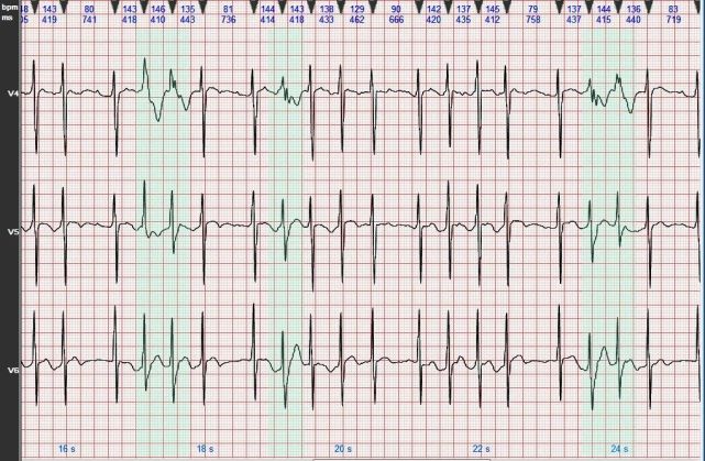 心电图图例分析10:心房扑动伴室内差异性传导部分呈蝉联现象