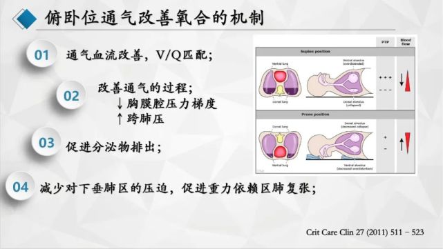 【课件】赵英培医师:俯卧位通气与营养