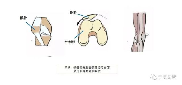 外侧髁的髌骨关节隆起较高,股内侧肌的内侧腱性扩张部与髌骨内侧支持