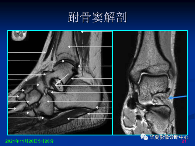 跗骨窦综合征影像诊断