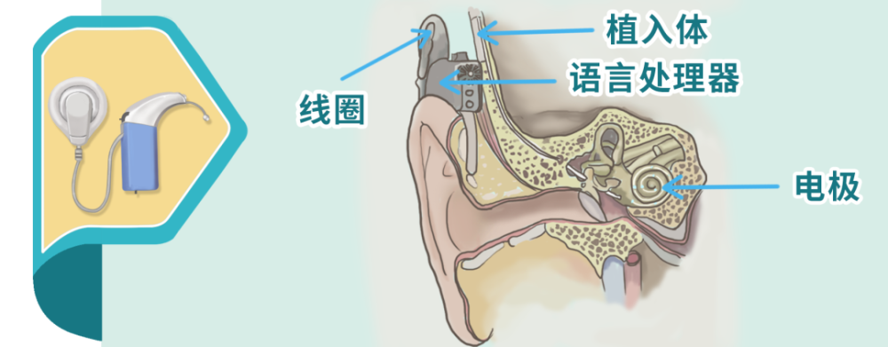 器,将收集的声音转换为电信号,通过植入耳蜗的电极刺激螺旋神经节细胞