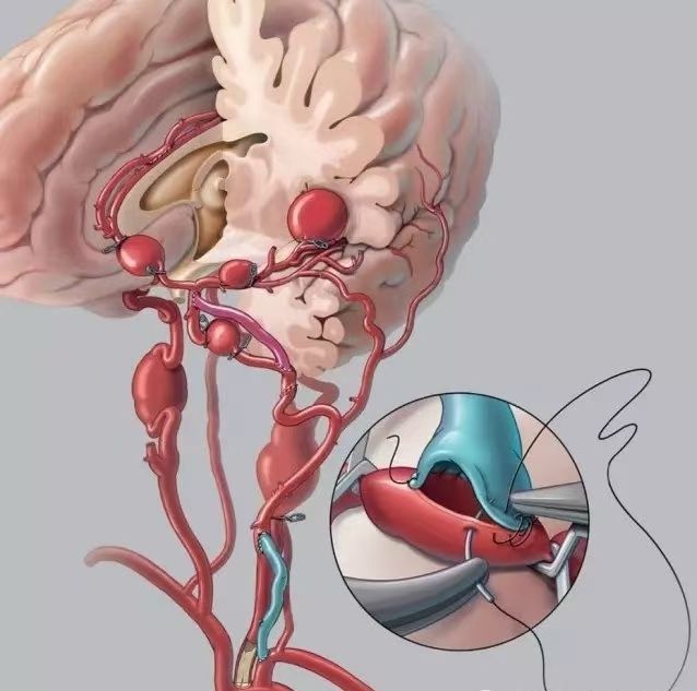 脑内血管willis环-脑血流独特的供血方式(4)