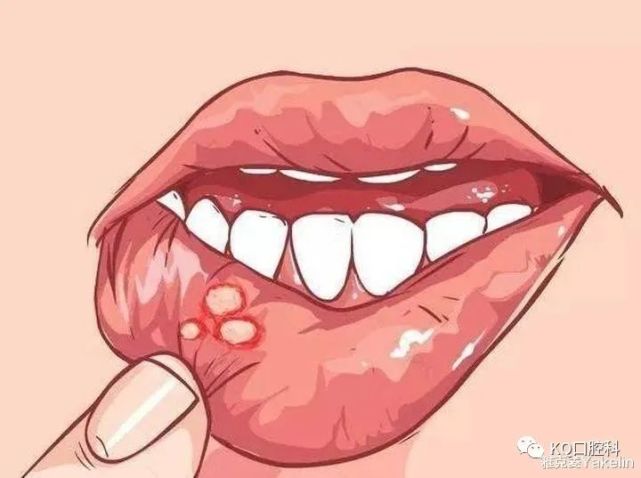 口腔溃疡其实就是细菌感染从而在口腔内引发炎症导致的,而全身性疾病