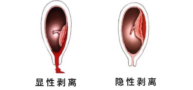 胎盘早剥有多凶险?若不是抢救及时,分分钟,宝宝可能就