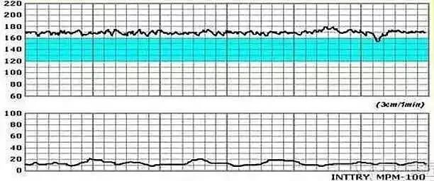 史上最全实图案例详解值得珍藏的胎心监护知识点