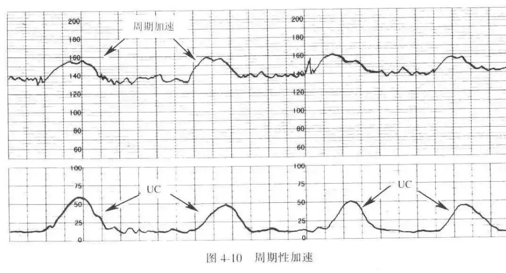 史上最全:实图 案例详解,值得珍藏的胎心监护知识点!