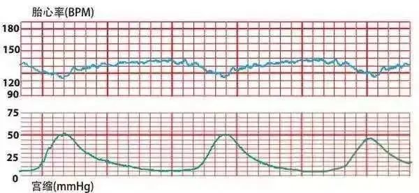 早期减速后期胎心持续80-100 bpm,产钳助产一男婴,脐带绕颈3周,轻度