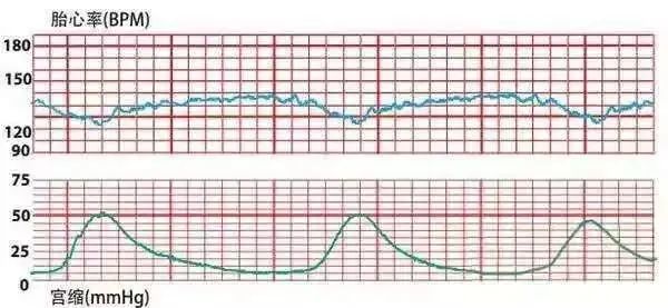 史上最全:实图 案例详解,值得珍藏的胎心监护知识点!