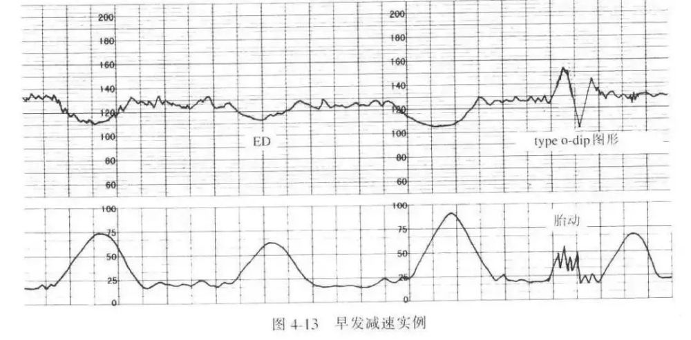 心动过速:>160次/分为伴随胎动而发生的加速后的减速.