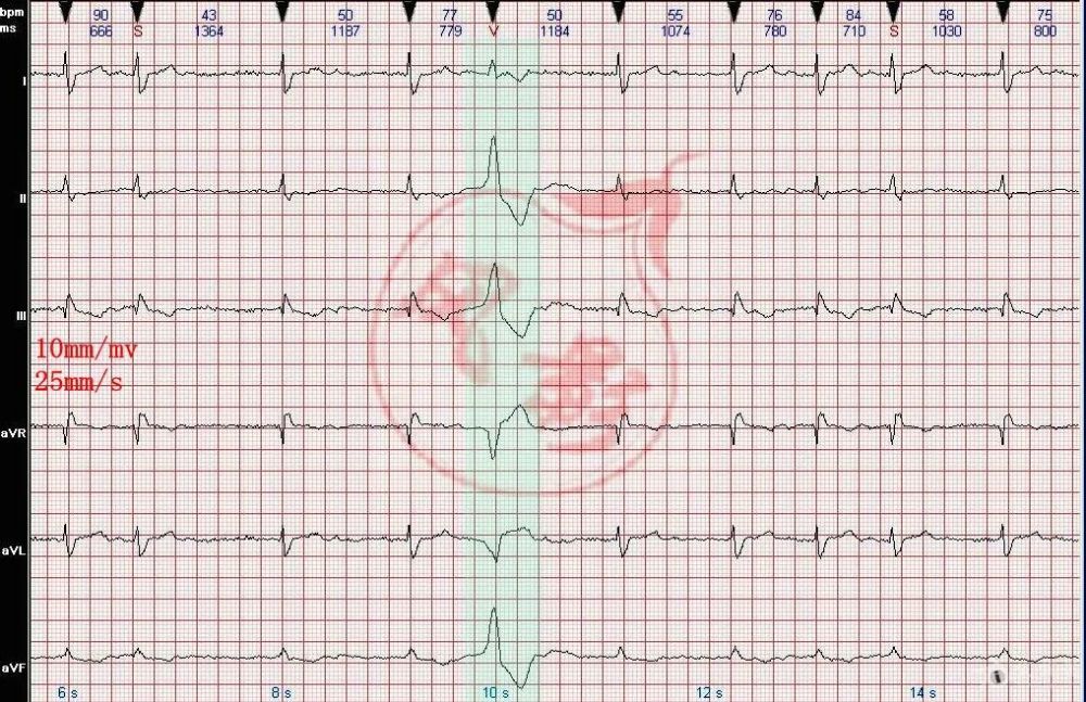 心电图图例分析11:心房颤动伴完全性右束支阻滞,室性早搏