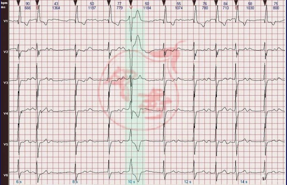 心电图图例分析11:心房颤动伴完全性右束支阻滞,室性早搏