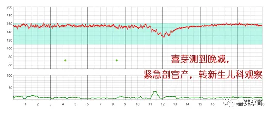 因此,当孕晚期出现假性宫缩,或者临产宫缩了,孕妈妈不必太过担忧胎