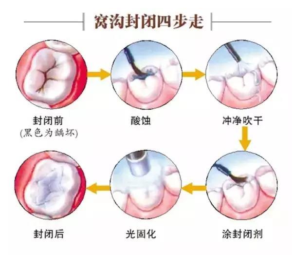 浅龋中龋可以补牙深龋牙髓炎要怎么办