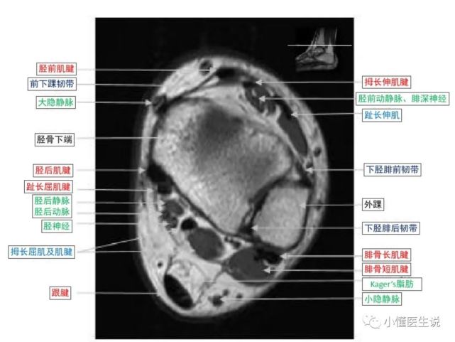 一文掌握|踝关节mr断层解剖