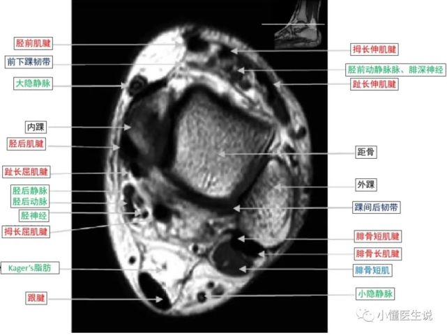 一文掌握|踝关节mr断层解剖