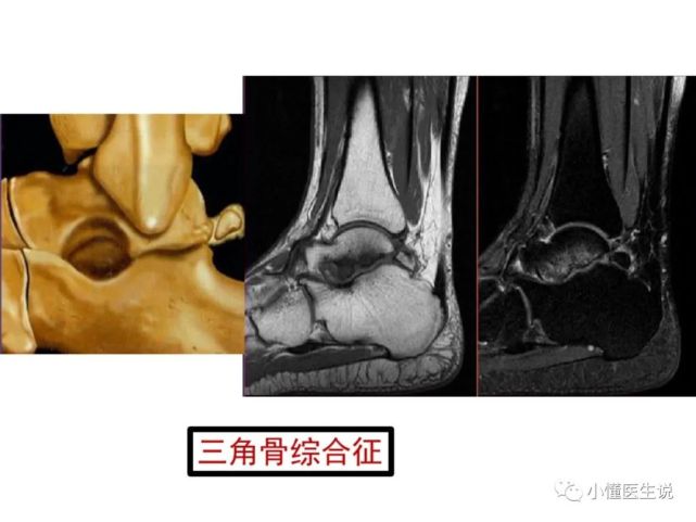 一文掌握|踝关节mr断层解剖